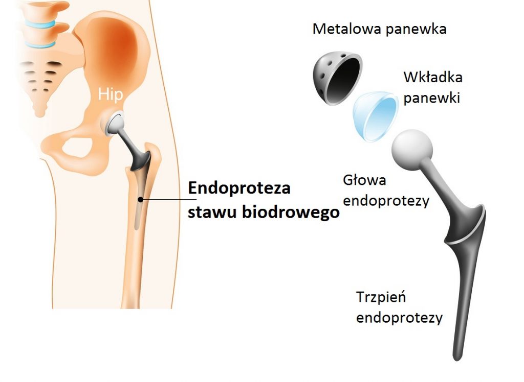 Endoproteza stawu biodrowego z czego jest zrobiona